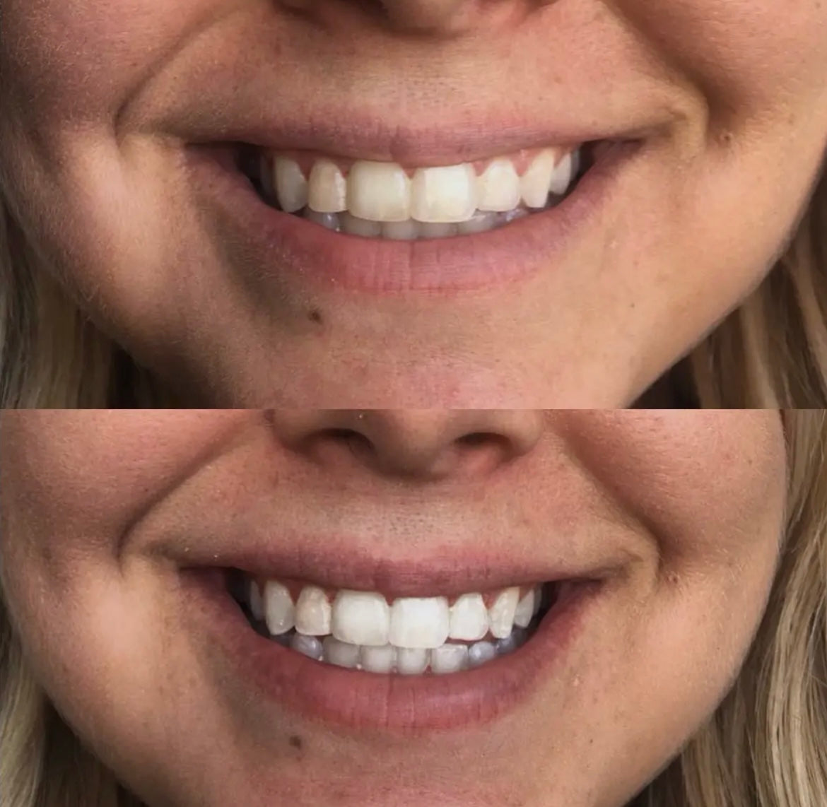 ANGEL STATUS SMILE KIT
